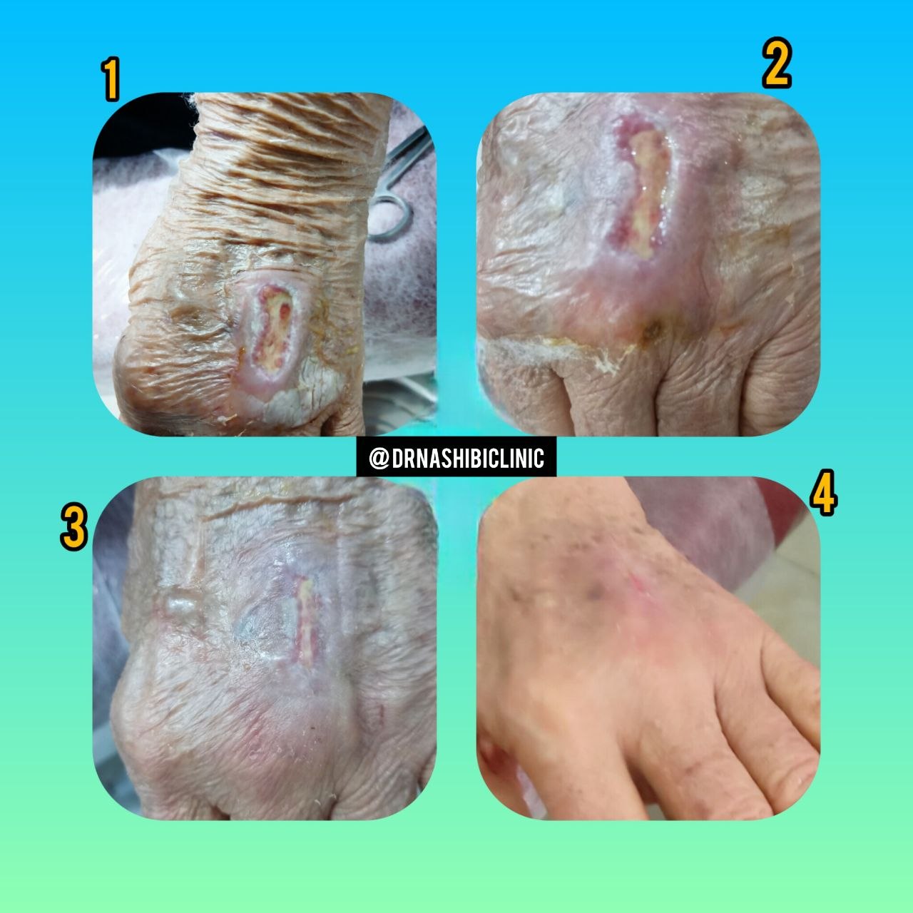  خانم 65 ساله دیابتی با سابقه فشار خون و به دنبال گزش سگ روی دست چپ
